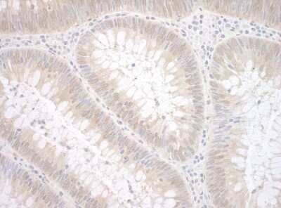 <b>Independent Antibodies Validation and Biological Strategies Validation.</b>Immunohistochemistry: ETS1 associated protein II Antibody [NBP1-46178] - Sample: FFPE section of human colon carcinoma. Antibody: Affinity purified rabbit anti-TDP2 used at a dilution of 1:200 (1ug/ml) Detection: DAB staining using Immunohistochemistry Accessory Kit .