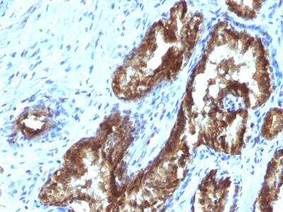 Immunohistochemistry-Paraffin: ETS1 associated protein II Antibody (TDP2/1258) [NBP2-50070] - Formalin-paraffin human Prostate Carcinoma stained with TDP2 MAb (TDP2/1258)