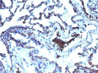 Immunohistochemistry-Paraffin: ETS1 associated protein II Antibody (TDP2/1258) [NBP2-50070] - Formalin-paraffin human Lung Carcinoma stained with TDP2 MAb (TDP2/1258)