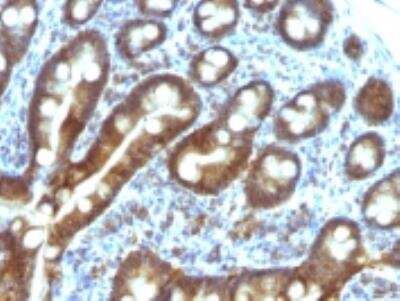 Immunohistochemistry-Paraffin: ETS1 associated protein II Antibody (TDP2/1258) [NBP2-50070] - Formalin-paraffin human Duodenal carcinoma stained with TDP2 Mab (TDP2/1258)