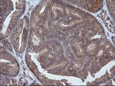 Immunohistochemistry: ETS2 Antibody (OTI2A3) [NBP2-45543] - Analysis of Carcinoma of Human thyroid tissue.