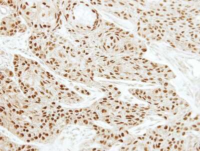 Immunohistochemistry-Paraffin: EWSR1 Antibody [NBP2-16389] - Immunohistochemical analysis of paraffin-embedded cal27 xenograft, using antibody at 1:100 dilution.