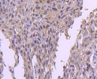Immunohistochemistry-Paraffin: EZH2/KMT6 Antibody (JJ089-9) [NBP2-67881] - Analysis of paraffin-embedded human breast carcinoma tissue using anti-KMT6/EZH2 antibody. Counter stained with hematoxylin.