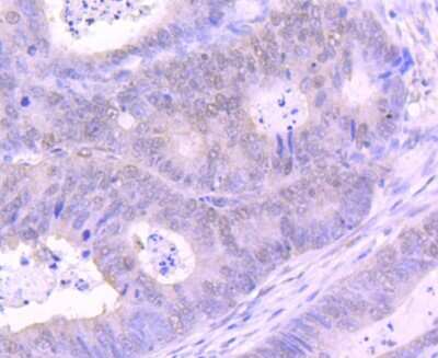 Immunohistochemistry-Paraffin: EZH2/KMT6 Antibody (JJ089-9) [NBP2-67881] - Analysis of paraffin-embedded human colon cancer tissue using anti-KMT6/EZH2 antibody. Counter stained with hematoxylin.