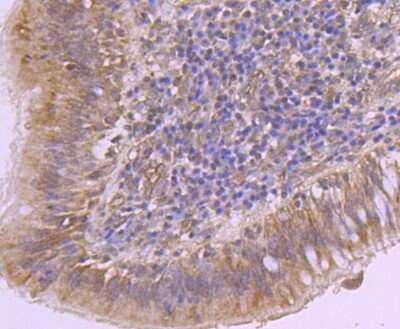 Immunohistochemistry-Paraffin: EZH2/KMT6 Antibody (JJ089-9) [NBP2-67881] - Analysis of paraffin-embedded human lung cancer tissue using anti-KMT6/EZH2 antibody. Counter stained with hematoxylin.