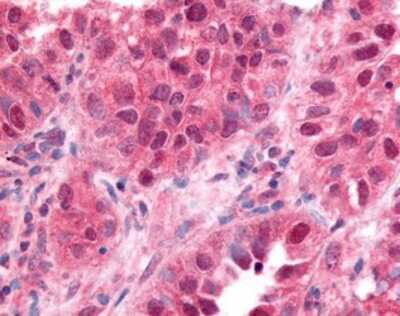 Immunohistochemistry-Paraffin: EGR1 Antibody [NBP1-02807] - Staining of human lung small cell carcinoma tissue after heat-induced antigen retrieval. Antibody concentration 10 ug/ml.