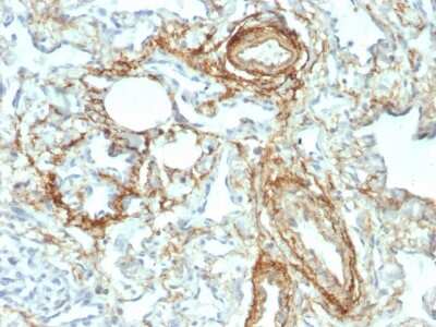 Immunohistochemistry-Paraffin: Elastin Antibody (ELN/2069) - Azide and BSA Free [NBP3-08889] - Formalin-fixed, paraffin-embedded human Angiosarcoma stained with Elastin Mouse Monoclonal Antibody (ELN/2069).