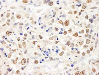Immunohistochemistry: Elongin A Antibody [NB100-40835] - Sample: FFPE section of human metastatic lymph node. Antibody: Affinity purified rabbit anti- TCEB3 used at a dilution of 1:1,000 (1ug/ml). Detection: DAB