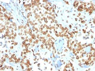 Immunohistochemistry-Paraffin: Emerin Antibody (EMD/2167) - Azide and BSA Free [NBP2-79918] - Formalin-fixed, paraffin-embedded human Breast Carcinoma stained with Emerin Mouse Monoclonal Antibody (EMD/2167).