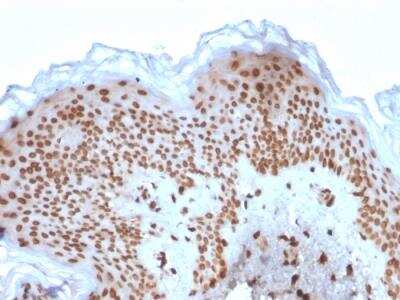 Immunohistochemistry-Paraffin: Emerin Antibody (EMD/2167) - Azide and BSA Free [NBP2-79918] - Formalin-fixed, paraffin-embedded human Basal Cell Carcinoma stained with Emerin Mouse Monoclonal Antibody (EMD/2167).