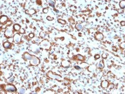 Immunohistochemistry-Paraffin: Emerin Antibody (EMD/2167) - Azide and BSA Free [NBP2-79918] - Formalin-fixed, paraffin-embedded human Renal Cell Carcinoma stained with Emerin Mouse Monoclonal Antibody (EMD/2167).