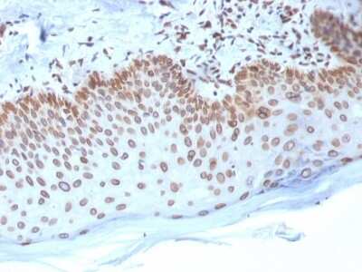 Immunohistochemistry-Paraffin: Emerin Antibody (EMD/2168) [NBP3-08893] - Formalin-fixed, paraffin-embedded human Breast Carcinoma stained with Emerin Mouse Monoclonal Antibody (EMD/2168).