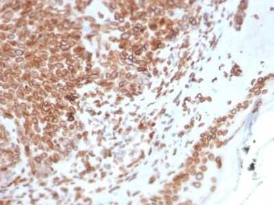 Immunohistochemistry-Paraffin: Emerin Antibody (EMD/2168) [NBP3-08893] - Formalin-fixed, paraffin-embedded human Basal Cell Carcinoma stained with Emerin Mouse Monoclonal Antibody (EMD/2168).