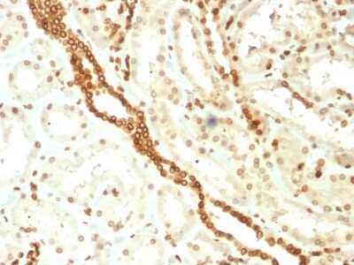 Immunohistochemistry-Paraffin: Emerin Antibody (EMD/2168) [NBP3-08893] - Formalin-fixed, paraffin-embedded human Renal Cell Carcinoma stained with Emerin Mouse Monoclonal Antibody (EMD/2168).