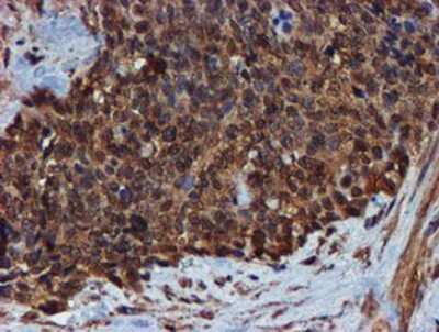 Immunohistochemistry-Paraffin: Endo G Antibody (5F1) [NBP2-01696] - Staining of paraffin-embedded Adenocarcinoma of Human breast tissue using anti-Endo G mouse monoclonal antibody.