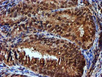 Immunohistochemistry-Paraffin: Endo G Antibody (5F1) [NBP2-01696] - Staining of paraffin-embedded Adenocarcinoma of Human endometrium tissue using anti-Endo G mouse monoclonal antibody.