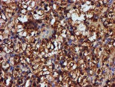 Immunohistochemistry-Paraffin: Endo G Antibody (5F1) [NBP2-01696] - Staining of paraffin-embedded Carcinoma of Human kidney tissue using anti-Endo G mouse monoclonal antibody.