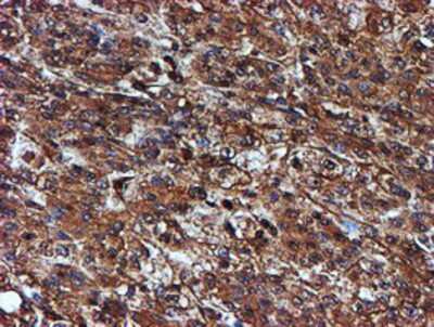 Immunohistochemistry-Paraffin: Endo G Antibody (5F1) [NBP2-01696] - Staining of paraffin-embedded Carcinoma of Human liver tissue using anti-Endo G mouse monoclonal antibody.