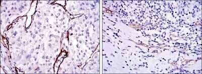 Immunohistochemistry: Endoglin/CD105 Antibody (3A9) - Azide and BSA Free [NBP2-80719] - Analysis of paraffin-embedded kidney cancer tissues (left) and stomach cancer tissues (right) using CD105 mouse mAb with DAB staining. Image from the standard format of this antibody.