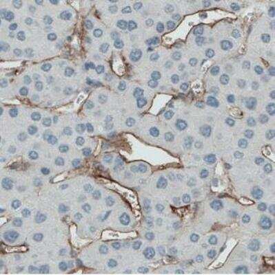 Immunohistochemistry-Paraffin: Endoglin/CD105 Antibody (CL1912) [NBP2-34493] - Staining of human liver cancer shows positivity in the sinusoids.