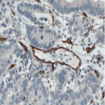Immunohistochemistry-Paraffin: Endoglin/CD105 Antibody (CL1912) [NBP2-34493] - Staining of human stomach cancer shows strong immunoreactivity in the blood vessels walls.