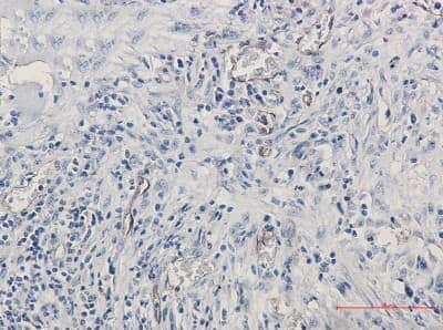 Immunohistochemistry-Paraffin: Endoglin/CD105 Antibody (S05-3H7) [NBP3-14875] - Immunohistochemistry of Endoglin/CD105 in paraffin-embedded Human lung cancer tissue using Endoglin/CD105 Rabbit mAb at dilution 1/50