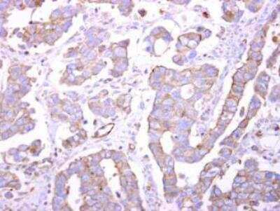 Immunohistochemistry-Paraffin: Endophilin B1/Bif-1 Antibody [NBP1-31130] - Bif-1 antibody detects Bif-1 protein at cytosol on human ovarian carcinoma by immunohistochemical analysis. Sample: Paraffin-embedded human ovarian carcinoma. Bif-1 antibody (NBP1-31130).Antigen Retrieval: Trilogy(TM) (EDTA based, pH 8.0) buffer, 15min