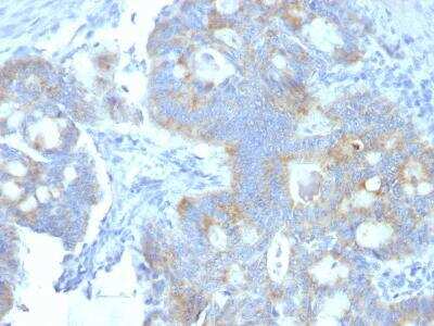Immunohistochemistry-Paraffin: Endorepellin/Perlecan/Heparan Sulfate Proteoglycan Antibody (A7L6) - Azide and BSA Free [NBP2-47695] - Formalin-fixed, paraffin-embedded human Colon Carcinoma stained with Heparan Sulfate Monoclonal Antibody (A7L6).
