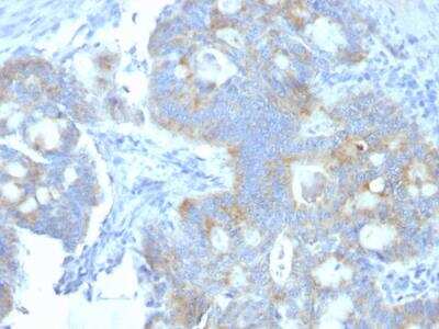 Immunohistochemistry-Paraffin: Endorepellin/Perlecan/Heparan Sulfate Proteoglycan Antibody (A7L6) - IHC-Prediluted [NBP2-48243] - Formalin-fixed, paraffin-embedded human Colon Carcinoma stained with Heparan Sulfate Monoclonal Antibody (A7L6).