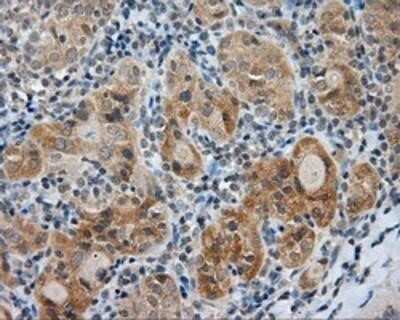 Immunohistochemistry: Endothelial Lipase Antibody (OTI1D9) - Azide and BSA Free [NBP2-71309] - Staining of paraffin-embedded Carcinoma of Human thyroid tissue using anti-Endothelial Lipase mouse monoclonal antibody.