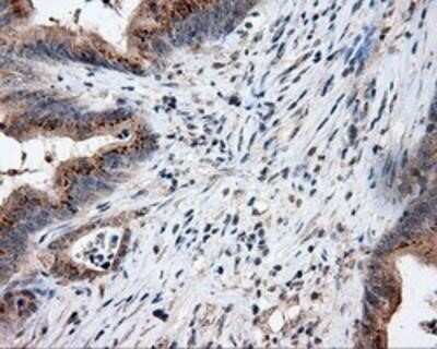 Immunohistochemistry-Paraffin: Endothelial Lipase Antibody (OTI1D9) [NBP2-02396] - Staining of paraffin-embedded Adenocarcinoma of Human colon tissue using anti-Endothelial Lipase mouse monoclonal antibody.