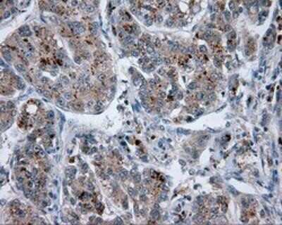 Immunohistochemistry-Paraffin: Endothelial Lipase Antibody (OTI1D9) [NBP2-02396] - Staining of paraffin-embedded Carcinoma of Human liver tissue using anti-Endothelial Lipase mouse monoclonal antibody.