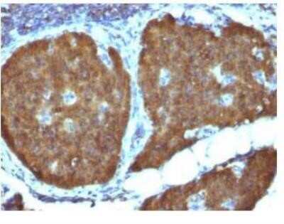 Immunohistochemistry-Paraffin: Enolase 2/Neuron-specific Enolase Antibody (ENO2/1462) - Azide and BSA Free [NBP2-59603] - Formalin-fixed, paraffin-embedded Human Pheochromocytoma stained with NSE gamma Monoclonal Antibody (ENO2/1462).