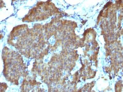 Immunohistochemistry-Paraffin: Enolase 2/Neuron-specific Enolase Antibody (SPM347) [NBP2-54590] - Formalin-fixed, paraffin-embedded Human Pheochromocytoma stained with NSE gamma Monoclonal Antibody (SPM347).