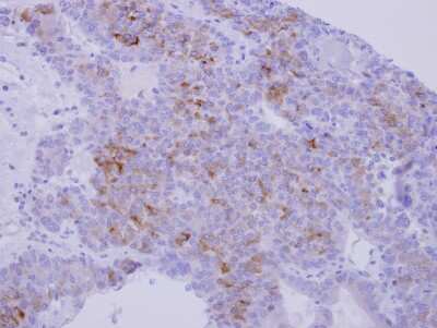 Immunohistochemistry-Paraffin: Nidogen-1/Entactin Antibody [NBP2-16341] -  Human liver carcinoma, using Nidogen antibody at 1:250 dilution. Antigen Retrieval: Trilogy™ (EDTA based, pH 8.0) buffer, 15min.