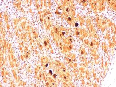 Immunohistochemistry-Paraffin: Enterovirus 71 2B Antibody [NBP3-13090] - EV71 2B antibody detects EV71 2B protein in EV71 infected mouse skeletal muscle by immunohistochemical analysis. Sample: Paraffin-embedded EV71 infected mouse skeletal muscle. EV71 2B antibody [NBP3-13090] diluted at 1:500 Antigen Retrieval: Citrate buffer