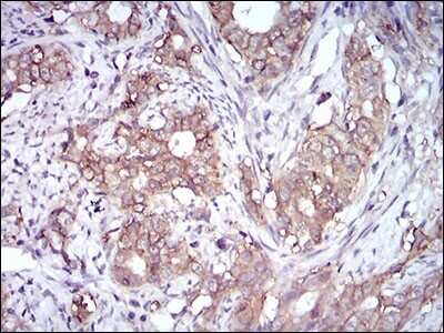 Immunohistochemistry: EpCAM/TROP1 Antibody (7B5C10) [NBP2-37256] - Immunohistochemical analysis of paraffin-embedded cervical cancer tissues using EPCAM mouse mAb with DAB staining.