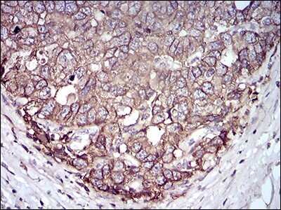 Immunohistochemistry: EpCAM/TROP1 Antibody (7B5C10) [NBP2-37256] - Immunohistochemical analysis of paraffin-embedded esophageal cancer tissues using EPCAM mouse mAb with DAB staining.