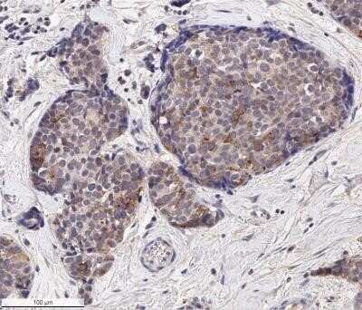 Immunohistochemistry: EpCAM/TROP1 Antibody (AUA1) - Azide and BSA Free [NBP2-80721] - Analysis of a FFPE human breast carcinoma tissue with 1:500 dilution of EpCAM/TROP1 antibody (clone AUA1) on a Bond Rx autostainer (Leica Biosystems). The assay involved 20 minutes of heat induced antigen retrieval (HIER) with 10mM sodium citrate buffer (