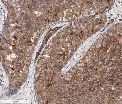 Immunohistochemistry-Paraffin: EpCAM/TROP1 Antibody (AUA1) - Azide and BSA Free [NBP2-80721] - Analysis of a FFPE human breast carcinoma tissue section using 1:100 dilution of EpCAM/TROP1 antibody (clone AUA1) on a Bond Rx autostainer (Leica Biosystems). The assay involved 20 minutes of heat induced antigen retrieval (HIER) with 10mM sodium citrate