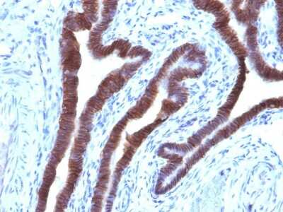 Immunohistochemistry-Paraffin: EpCAM/TROP1 Antibody (EGP40/1110) - (ECD) - IHC-Prediluted [NBP2-48264] - Formalin-fixed, paraffin-embedded human Ovarian Carcinoma stained with EpCAM Mouse Monoclonal Antibody (EGP40/1110).