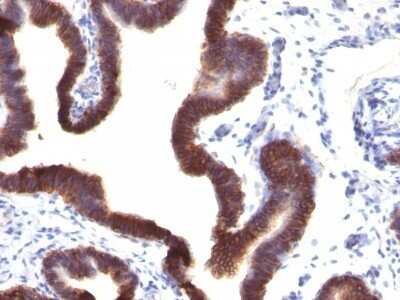 Immunohistochemistry-Paraffin: EpCAM/TROP1 Antibody (EGP40/1120) - Azide and BSA Free [NBP2-47874] - Human Ovarian Carcinoma stained with Ep-CAM Monoclonal Antibody (EGP40/1120).