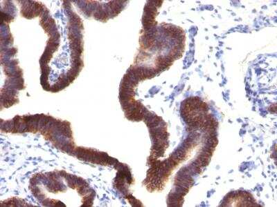 Immunohistochemistry-Paraffin: EpCAM/TROP1 Antibody (EGP40/1120) - IHC-Prediluted [NBP2-48265] - Formalin-fixed, paraffin-embedded human Ovarian Carcinoma stained with EpCAM Mouse Monoclonal Antibody (EGP40/1120).
