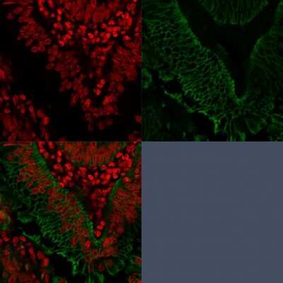 Immunocytochemistry/Immunofluorescence: EpCAM/TROP1 Antibody (EGP40/1372) - (ECD) - Azide and BSA Free [NBP2-54419] - Confocal Immunofluorescence of human Colorectal Carcinoma. NBP2-53264 labeled with CF488 (green); Nuclei are labeled with Reddot (red).