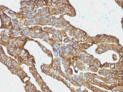 Immunohistochemistry-Paraffin: EpCAM/TROP1 Antibody (EGP40/1372) - (ECD) - Azide and BSA Free [NBP2-54419] - Formalin-fixed, paraffin-embedded Human Colorectal Carcinoma stained with EpCAM Monoclonal Antibody (EGP40/1372).