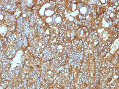 Immunohistochemistry-Paraffin: EpCAM/TROP1 Antibody (EGP40/1372) - (ECD) - Azide and BSA Free [NBP2-54419] - Formalin-fixed, paraffin-embedded human Hepatocellular Carcinoma stained with NBP2-53264.