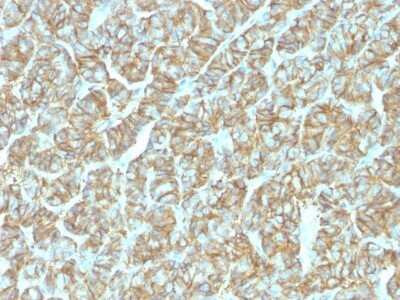 Immunohistochemistry-Paraffin: EpCAM/TROP1 Antibody (EGP40/1555R) - (ECD) - Azide and BSA Free [NBP2-54424] - Formalin-fixed, paraffin-embedded human Thyroid Carcinoma stained with Ep-CAM Recombinant Rabbit Monoclonal Antibody (EGP40/1555R).