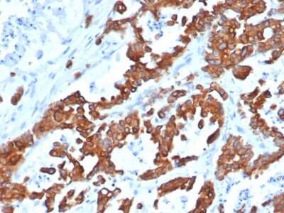 Immunohistochemistry-Paraffin: EpCAM/TROP1 Antibody (EGP40/1555R) - (ECD) - Azide and BSA Free [NBP2-54424] - Formalin-fixed, paraffin-embedded human prostate carcinoma stained with EpCAM/TROP1 Antibody (EGP40/1555R) - (ECD).