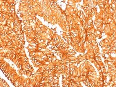 Immunohistochemistry-Paraffin: EpCAM/TROP1 Antibody (EGP40/1556R) - Azide and BSA Free [NBP2-54425] - Formalin-fixed, paraffin-embedded human Colon Carcinoma stained with Ep-CAM Recombinant Rabbit Monoclonal Antibody (EGP40/1556R).