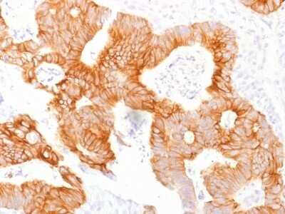 Immunohistochemistry-Paraffin: EpCAM/TROP1 Antibody (EGP40/1798) - (ECD) [NBP2-53213] - Formalin-fixed, paraffin-embedded Human Colorectal Carcinoma stained with Ep-CAM Monoclonal Antibody (EGP40/1798).